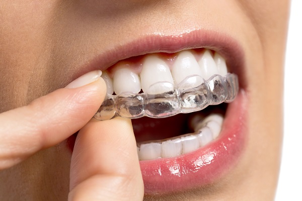 Wady ortodontyczne. Wady ortodontyczne i możliwości leczenia Invisalign.