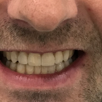 Połączenie ortodoncji przy zastosowaniu nakładek Invisalign® i protetyki daje spektakularne efekty!