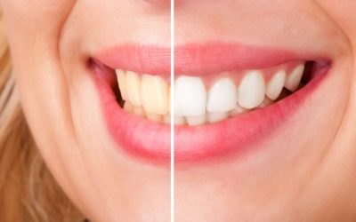 Wybielanie zębów a leczenie ortodontyczne