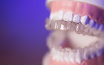 Stripping – zabieg stosowany przy leczeniu ortodontycznym