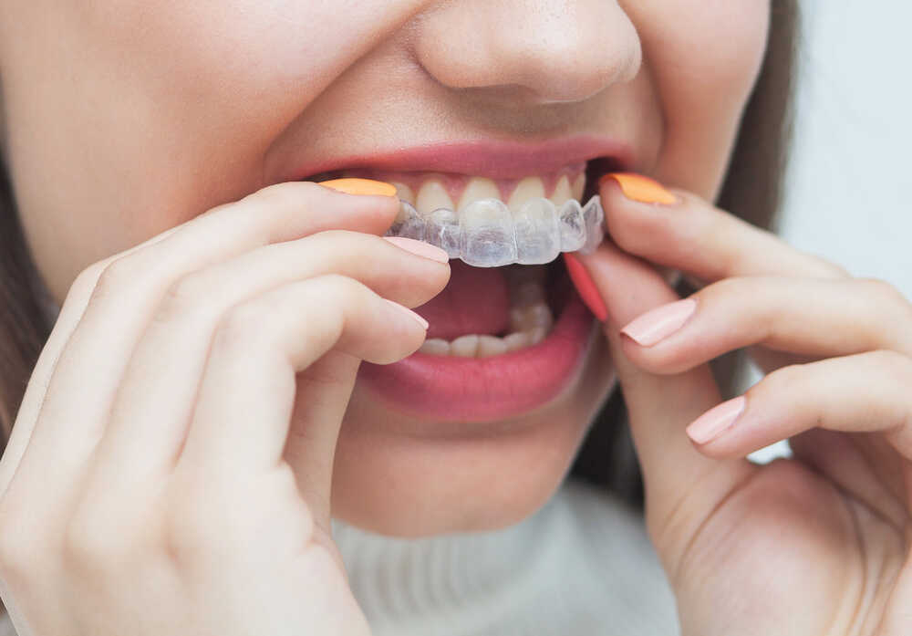 Kobieta dwoma rękoma zakłada aparat Invisalign