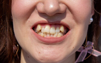 Krzywe zęby – czym są i jakie są metody ich leczenia?