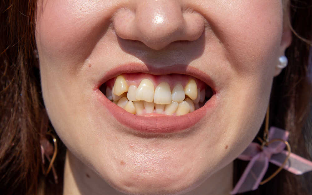 Krzywe zęby kobiety w przybliżeniu