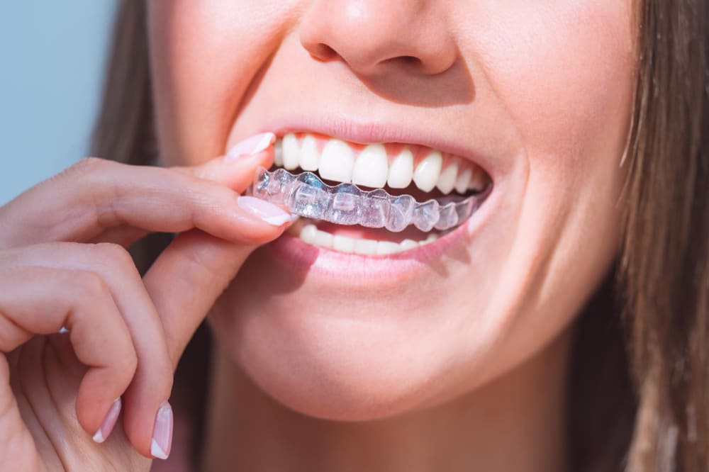 Kobieta zakłada nakładkę Invisalign